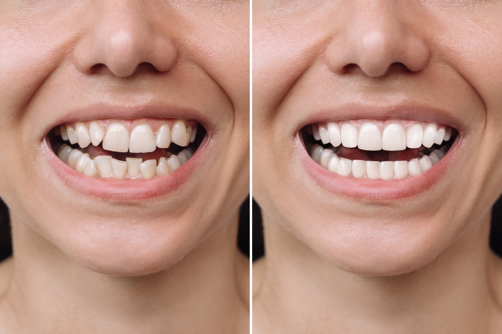 Antes y después de blanqueamiento dental profesional en Clínica Barcelona