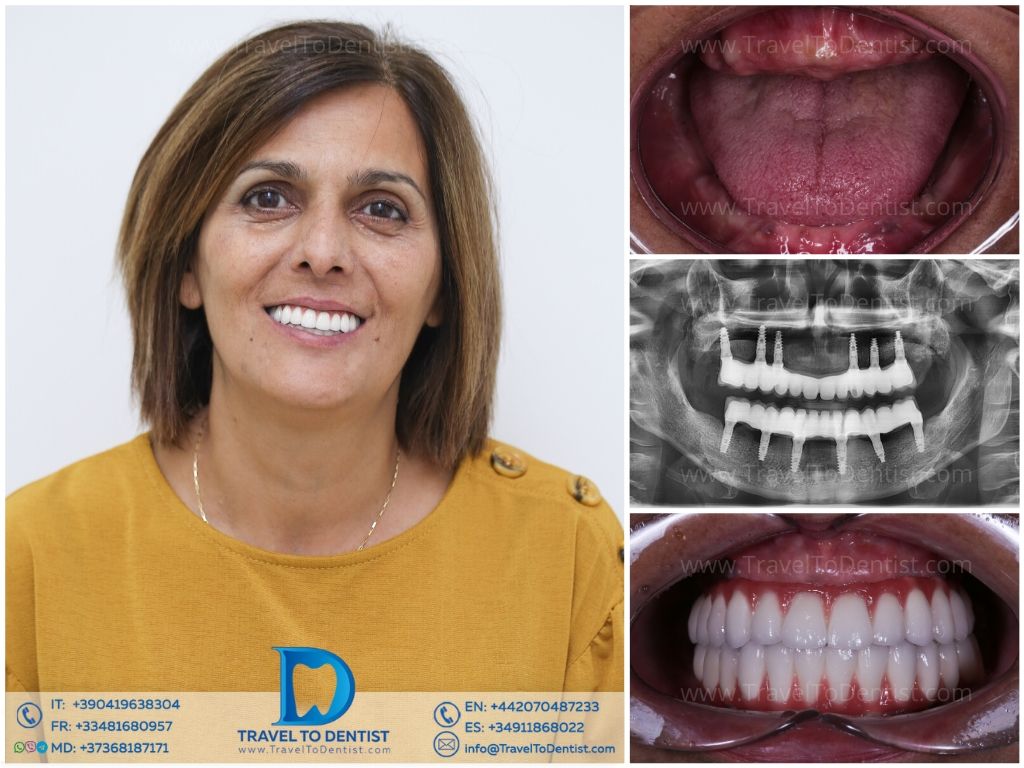 Tratamiento de endodoncia y restauración estética en Clínica Barcelona
