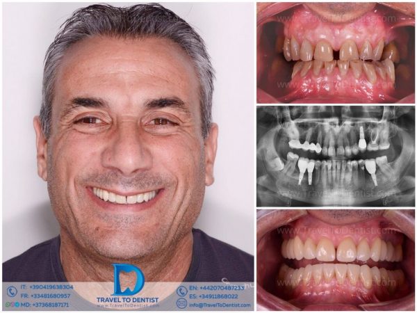 Resultado de tratamiento de ortodoncia mostrando alineación dental perfecta